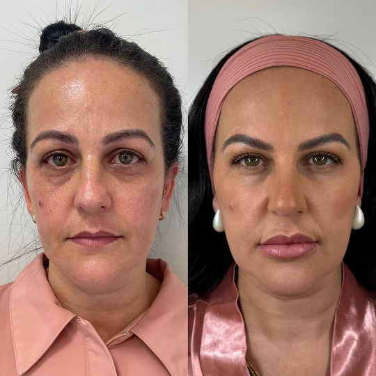 Antes e Depois